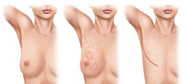 Mastectomy for breast