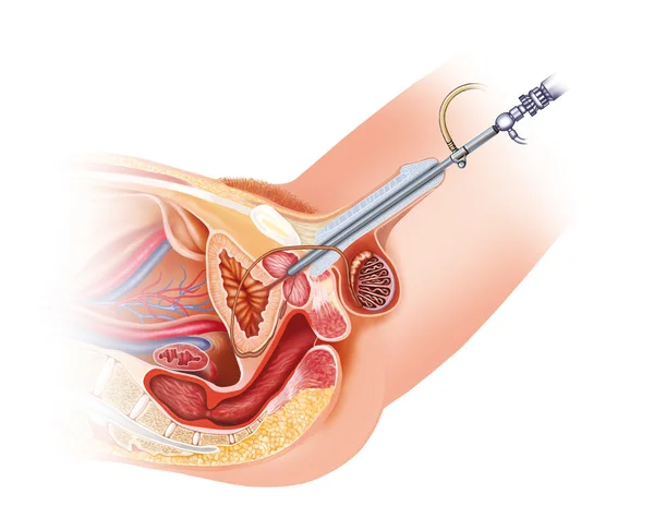 Mannelijke cistoscopia — Stockfoto