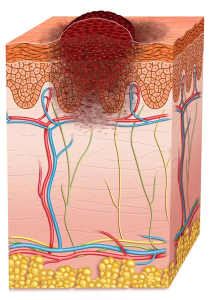 Melanoma — Foto Stock