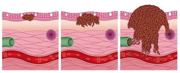 Los estadios del cáncer — Foto de Stock