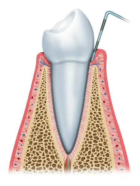 Periodontitis sürecinde — Stok fotoğraf