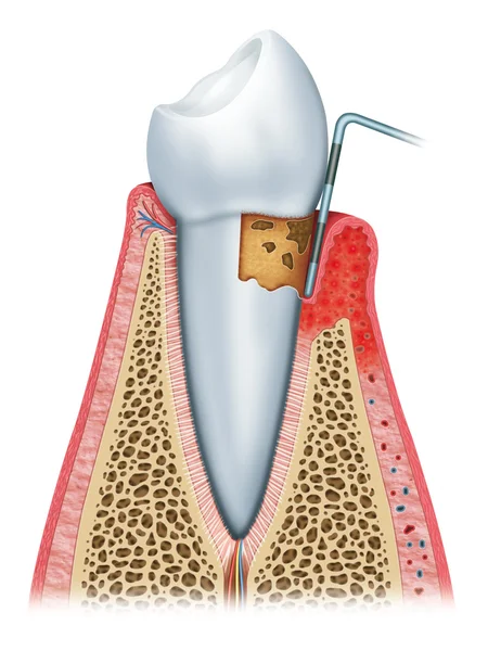 Periodontitis yarısı — Stok fotoğraf