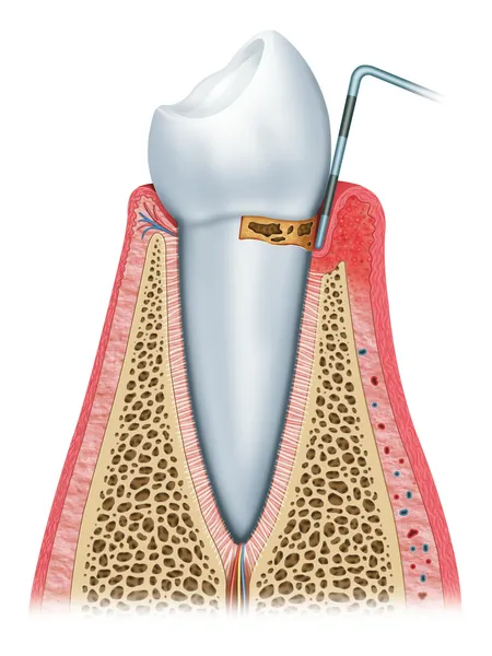 Periodontitis inicial — Foto de Stock