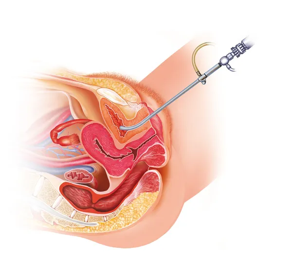 여성 cistoscopia 스톡 이미지