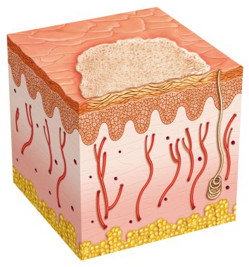 Basal cell carcinoma clipart
