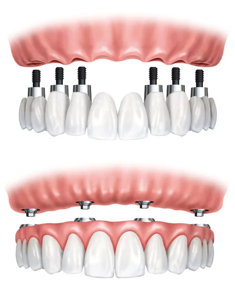 Dental prostheses — Stock Photo, Image