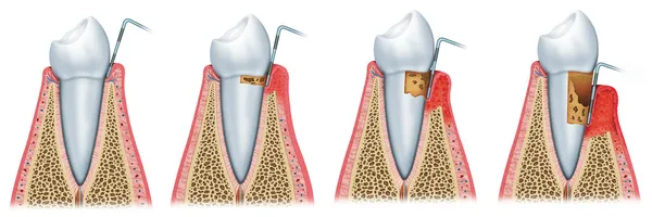 Desarrollo de periodontitis — Foto de Stock