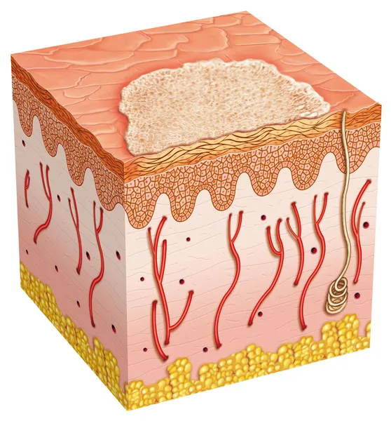 Carcinoma basocelular — Foto de Stock