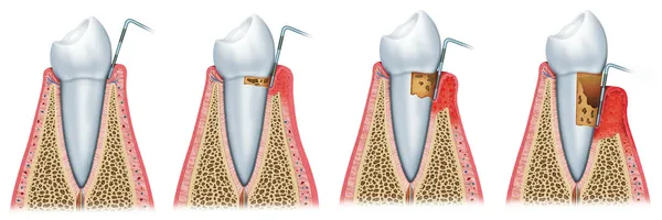 Vznik parodontitidy Stock Snímky
