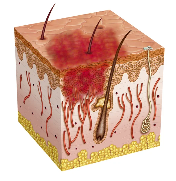 Carcinoma de — Fotografia de Stock