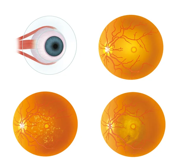 Enfermedad retiniana — Foto de Stock