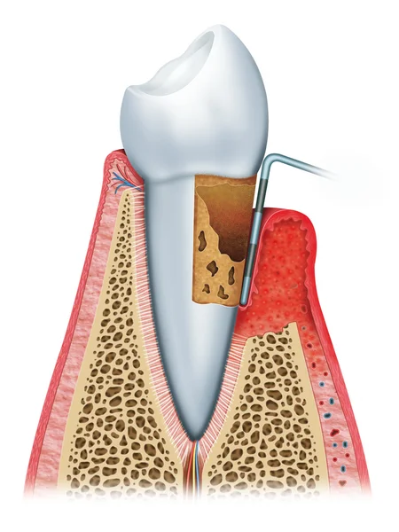 Gingivitis with advanced — Stock Photo, Image