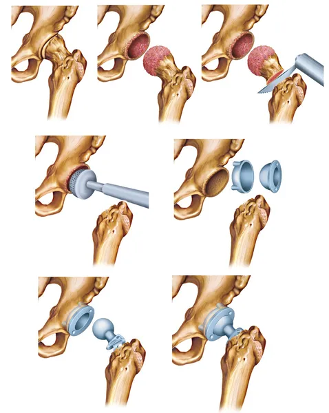 kalça osteoartriti