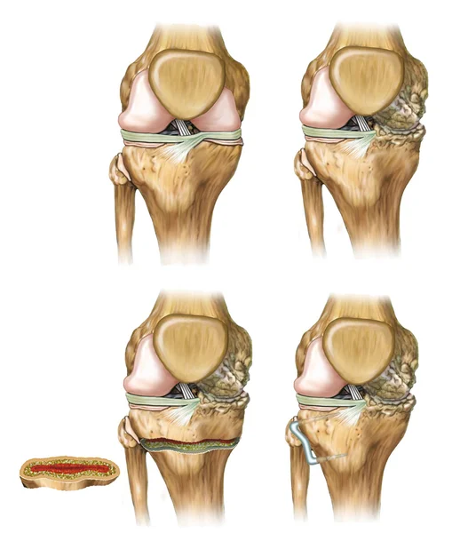 Knie deflectie — Stockfoto