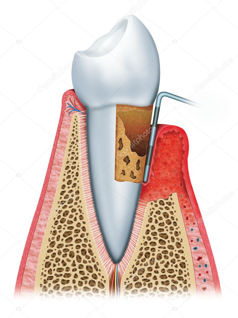 gingivitis with advanced