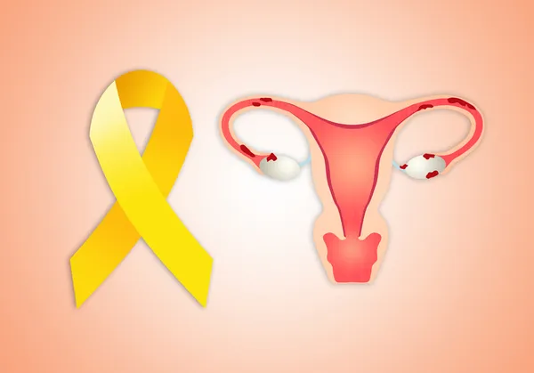 Endometrios — Stockfoto