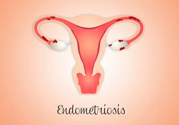 Endometriose Imagens Royalty-Free