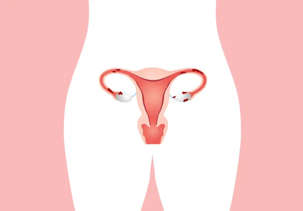 Endometriose Imagem De Stock