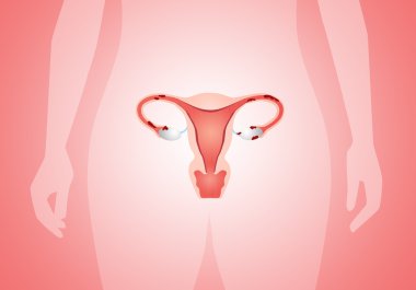 Endometriosis clipart