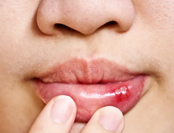 Mouth ulce — Stock Photo, Image