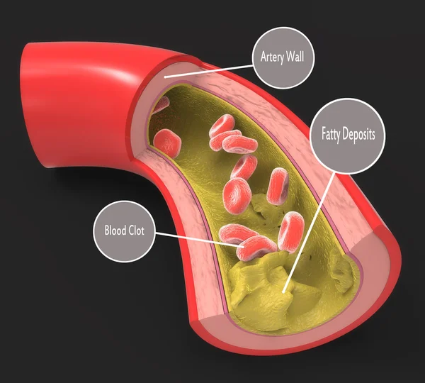 Kranke Arterie mit Fettdepots — Stockvektor