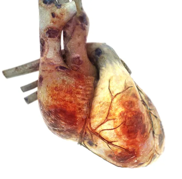 Anatomia del cuore malato — Foto Stock