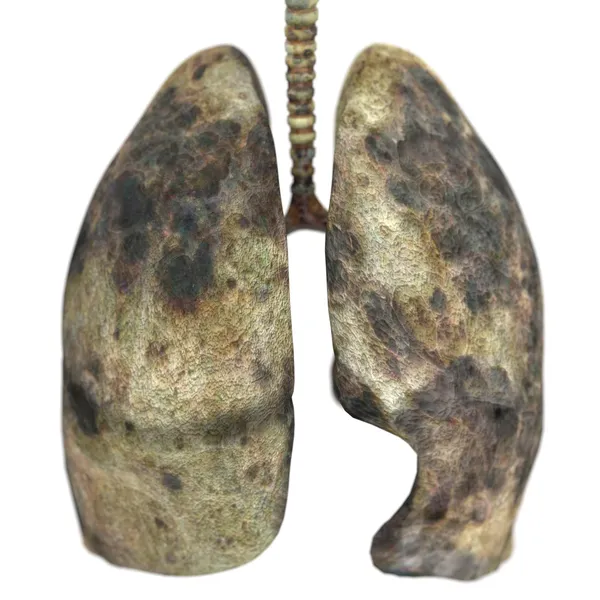 Diseased lungs — Stock Photo, Image