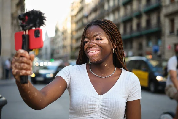 Young Female Influencer Vitiligo Smiling While Streaming Her Mobile Phone — Stock Photo, Image