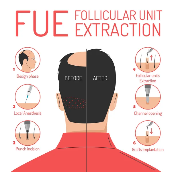 Hog Haartransplantatie Proces Vector Geïsoleerd Folliculaire Eenheid Extractie Procedure Kaalheid — Stockvector