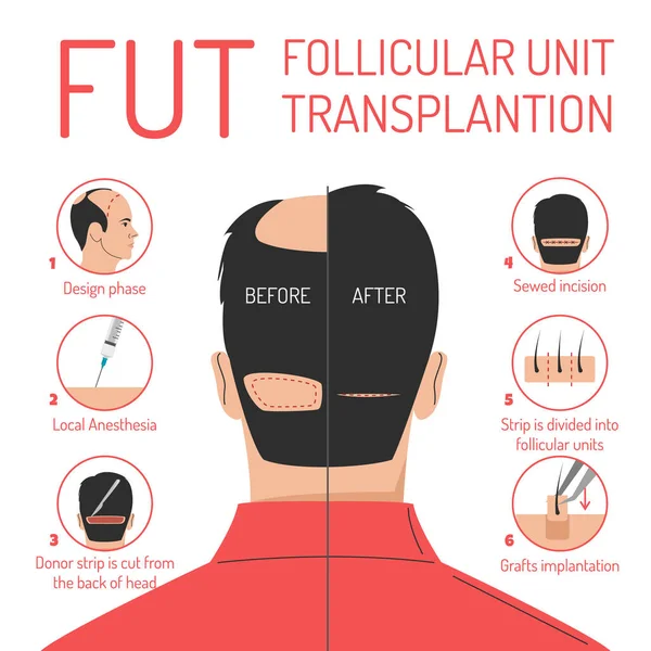 Fut Haartransplantatie Proces Vector Geïsoleerd Folliculaire Unit Transplantatie Kaalheid Probleem — Stockvector