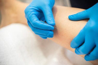 Fizyoterapi merkezinde kuru iğne yapan fizyoterapistin ellerine ve iğnesine yakın çekim..