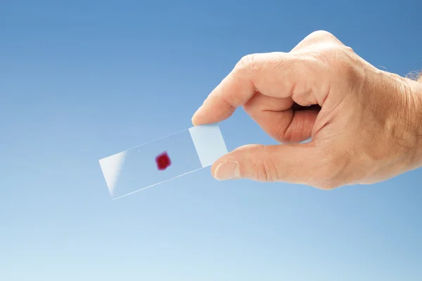 Die Objektträger für die mikroskopische zytologische Biopsieforschung — Stockfoto