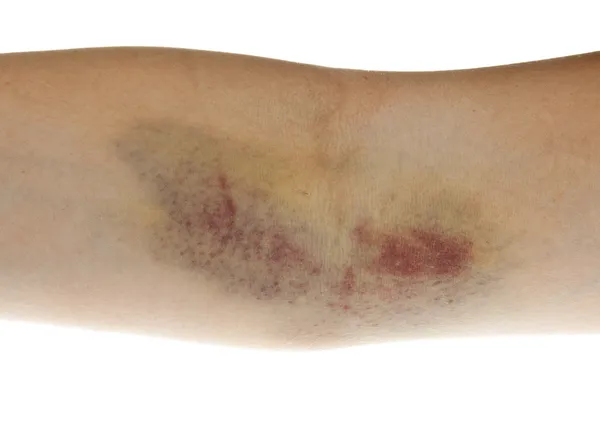 Hematoma — Fotografia de Stock