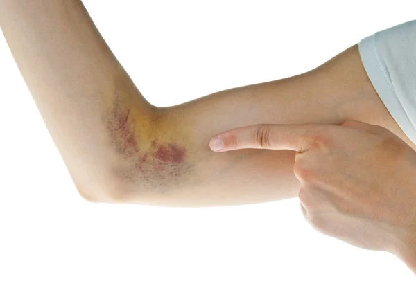 Hematoma — Stock Photo, Image