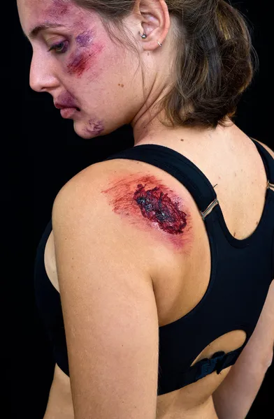 Injured woman with open wound — Stock Photo, Image