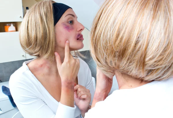 Mulher coberta de hematomas na frente do espelho — Fotografia de Stock