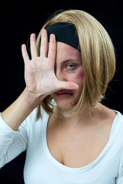 Woman with bruises — Stock Photo, Image