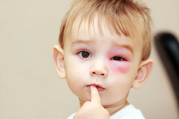 Маленький мальчик с укусами ос у глаза — стоковое фото