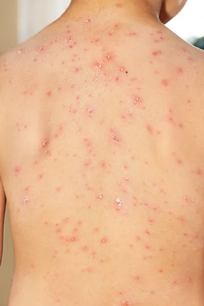 Exantema de varíola — Fotografia de Stock