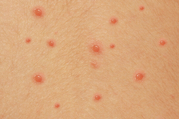 chicken pox rash