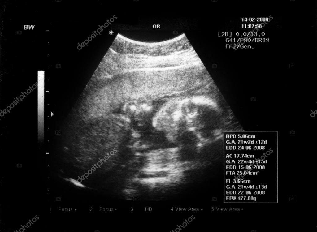 Baby ultrasound Stock Photo by ©benedamiroslav 23065514