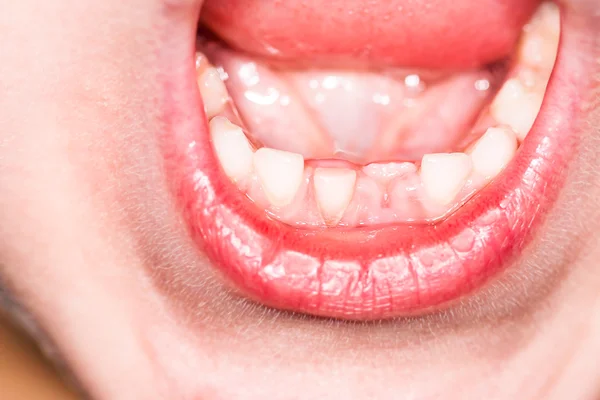 Genç çocuk ekşitmeden gösteriş yaptığı ilk eksik süt diş — Stok fotoğraf