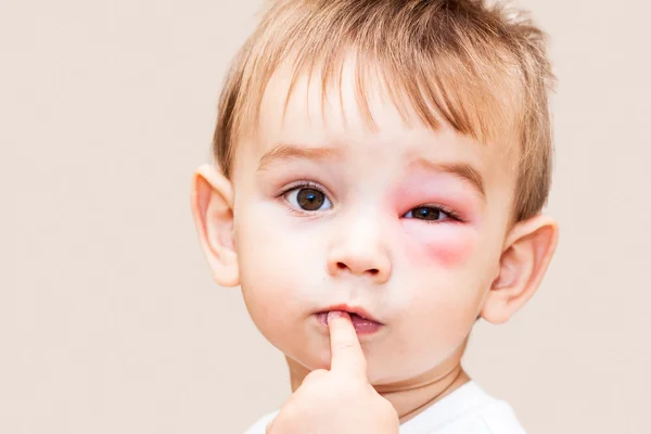 Little Boy - Dangerous Stings From Wasps Near The Eye — Stock Photo, Image