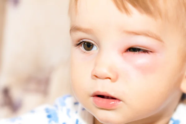 Niño pequeño - picaduras peligrosas de avispas cerca del ojo —  Fotos de Stock