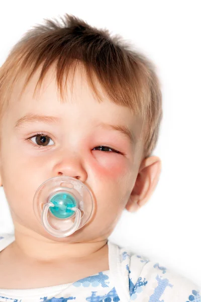 Niño pequeño - picaduras peligrosas de avispas cerca del ojo — Foto de Stock