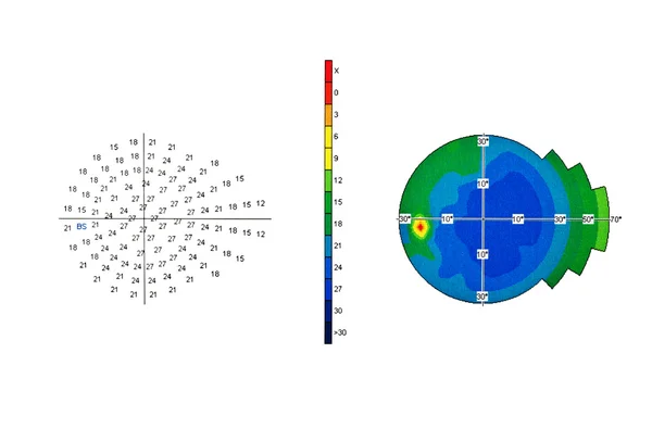 Eye test — Stock Photo, Image