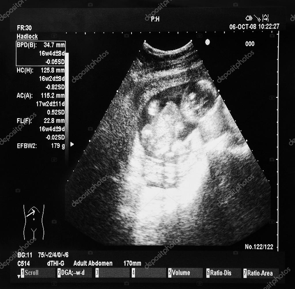 Ultrazvuk miminko — Stock Fotografie © wabeno 22412085