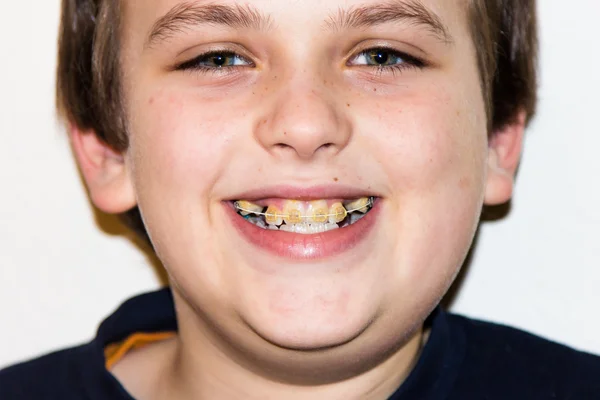 Frenos y dientes blancos del niño sonriente — Foto de Stock