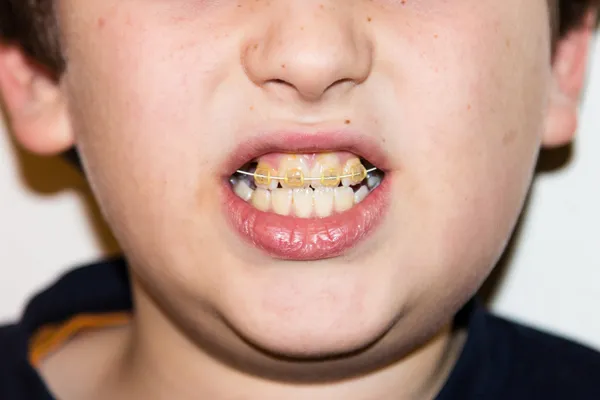 Брекети і білі зуби усміхненого хлопчика — стокове фото