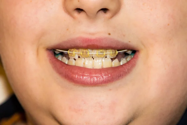 Nawiasy klamrowe i białe zęby uśmiechnięty chłopiec — Zdjęcie stockowe
